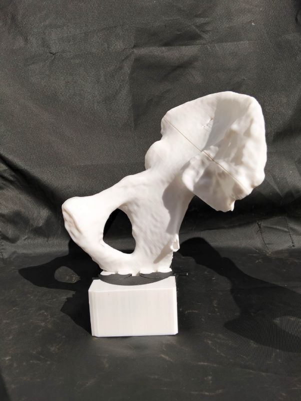 Modelo quirúrgico 3D — hemipelvis fracturada